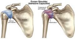 Adhesive capsulitis (frozen shoulder)