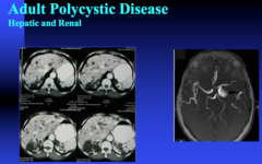 adult polycystic disease - hepatic and renal on CT