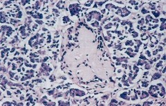 Amyloidosis of pancreas - type 2 DM