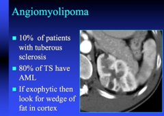 angiomyolipoma is associated with what?  if exophytic what do you look for?