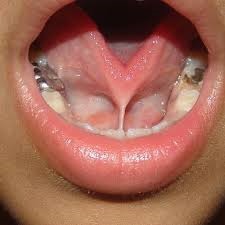 Ankyloglossia