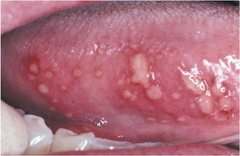 Aphthous ulcer Herpetiform