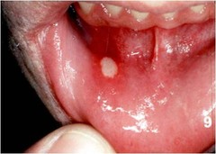 Aphthous ulcer major