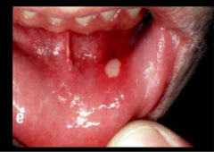 Aphthous Ulcer minor