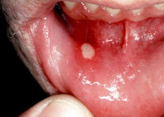 Aphthous Ulcer Physical Findings