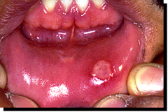 Aphthous Ulcer