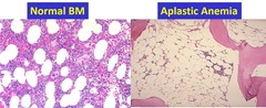 Aplastic Anemia