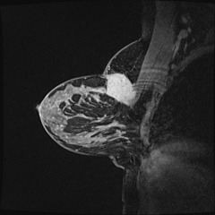 appearance of pectoral muscle invasion on MRI