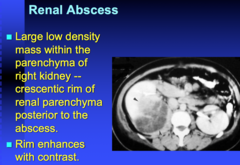 appearance of renal abscess on CT