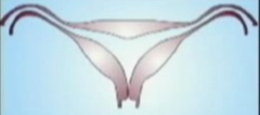 Arcuate uterus: defect, description, risks