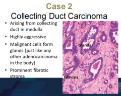Are collecting duct carcinomas malignant or benign? Are they common or rare? What type of carcinoma are they? What are some key features? Are they peripheral or central?