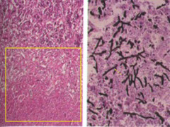 Aspergillus infxn of pituitary gland