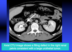 axial CTU is most often done for what kidney pathology?