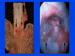 Barrett's Esophagus