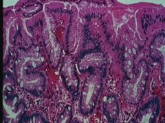 Barrett's histopathology