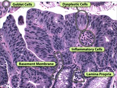 Barrett's with HG Dysplasia