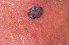 basal cell carcinoma: pigmented type  brown, blue or black with smooth, glistening surface