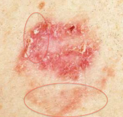 Basal cell carcinoma / Superficial
