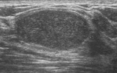 benign features of solid breast masses on ultrasound
