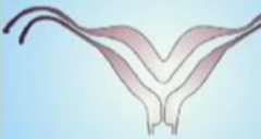 Bicornuate uterus: defects, description, types, risks