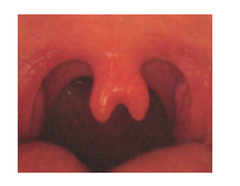 bifurcated uvula