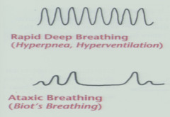 Biots breathing