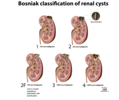 Bosniak classification of renal cysts
