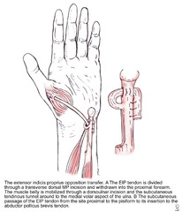 Bunnell FDS of ring (IV) Transfer for low median nerve injury: MOST PREFERRED