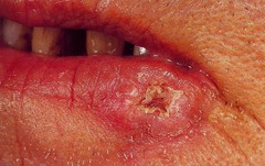 Cancer of the Lower Lip Physical Finding
