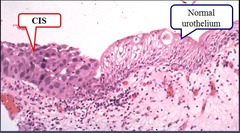 Carcinoma in situ (CIS)