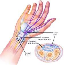 Carpal tunnel syndrome