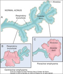 Centriacinar emphysema