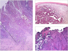 Cervical cancer Histopath