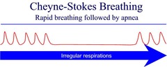 Cheyne Stokes breathing