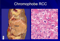 Chromophobe RCC  -prognosis compared to clear cell and papillary? -gross appearance?  -histo