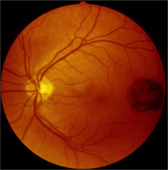 Congenital Anomalies of the Retina | StudyHippo.com