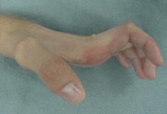 Claw deformity: Ulnar nerve laceration/compression