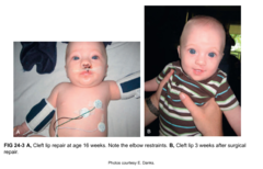 Cleft lip and cleft palate