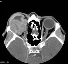 Clinical detection Orbital Pseudotumor