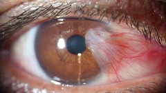 Clinical detection Pterygium