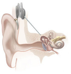 Cochlear implant (CI)