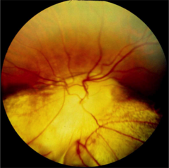 Congenital Anomalies of the Retina | StudyHippo.com
