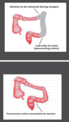 Colon Cancer Stage I  Treatment