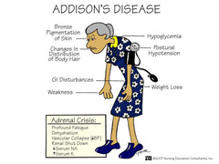 Common symptoms of Addison's Disease