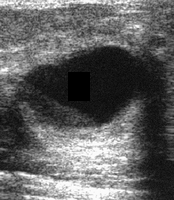 complicated breast cysts on ultrasound