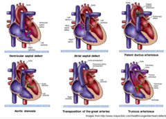 congenital heart defect image
