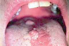 Contyloma Acuminatum of the Tongue