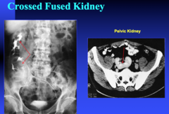 cross fused kidney