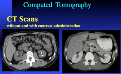 CT with and without contrast - what are the enhancement phases you can use to eval the kidney?