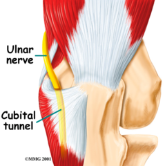 Cubital tunnel syndrome